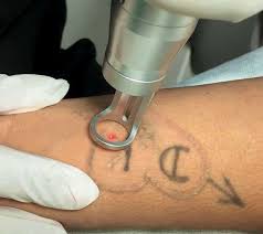 Tattoo Removal