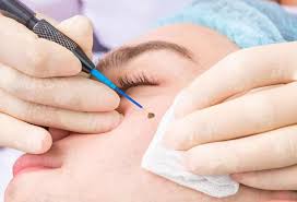 Wart / Mole Removal